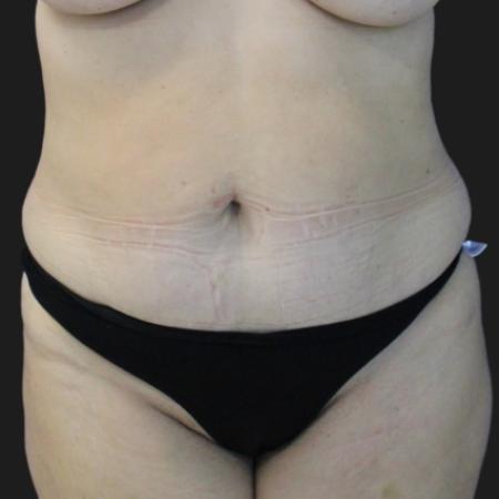 Before image 3 Case #116601 - 53 year-old patient | Mommy Makeover