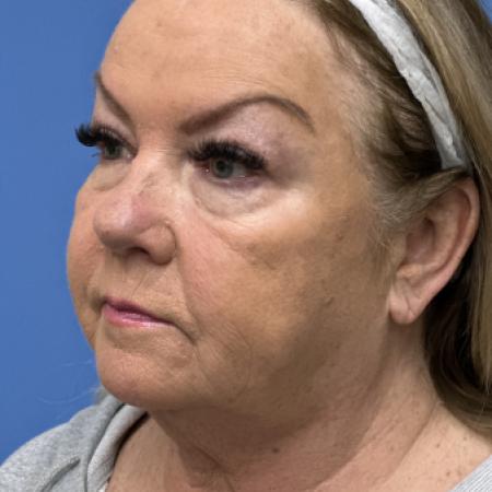 Before image 2 Case #117311 - 64 year old-Facelift/Blepharoplasty