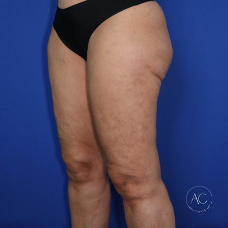 After image 2 Case #117281 - Circumferential Thigh Liposuction