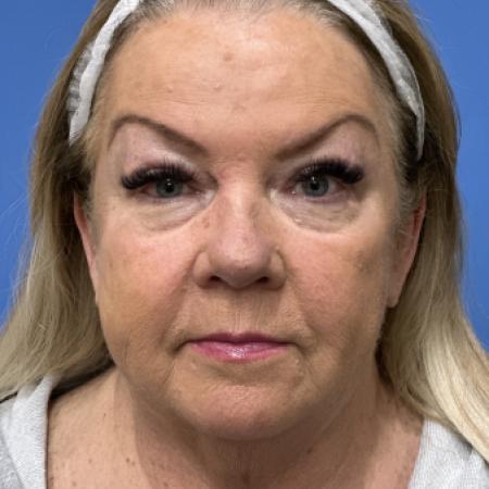 Before image 1 Case #117311 - 64 year old-Facelift/Blepharoplasty