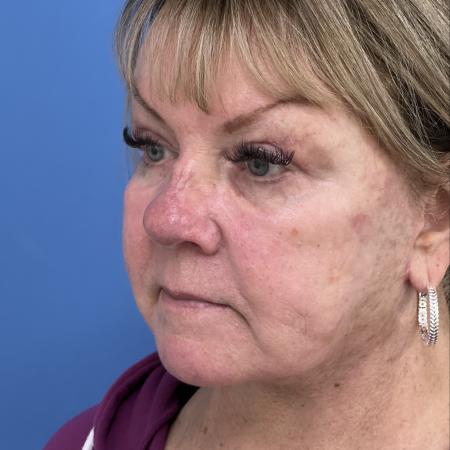After image 2 Case #117311 - 64 year old-Facelift/Blepharoplasty