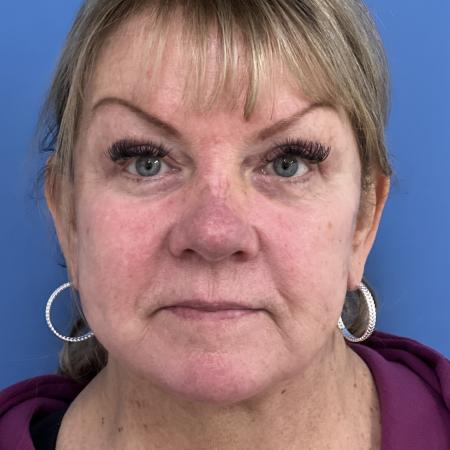 After image 1 Case #117311 - 64 year old-Facelift/Blepharoplasty