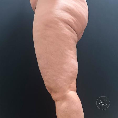 Before image 3 Case #117281 - Circumferential Thigh Liposuction