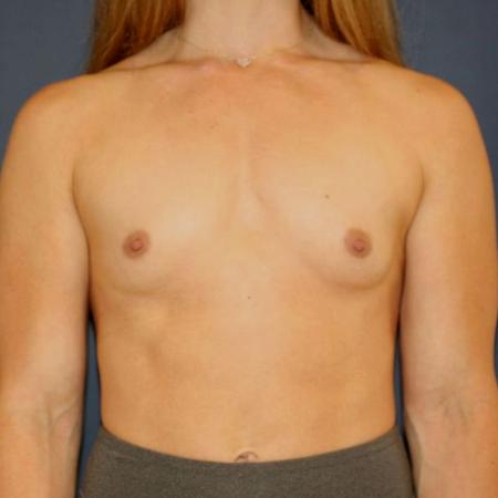 Before image 1 Case #117516 - Breast Augmentation