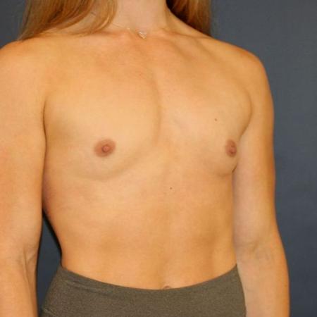 Before image 2 Case #117516 - Breast Augmentation