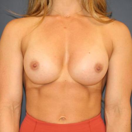 After image 1 Case #117516 - Breast Augmentation