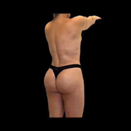 After Case #118236 - LipoEsculture and Gluteal Fat Grafting 