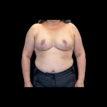 After image 1 Case #118126 - Breast Lift without Implants 