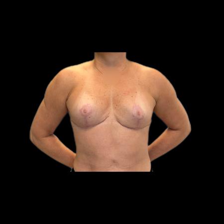 After image 1 Case #118141 - Mastopexy without Implants 