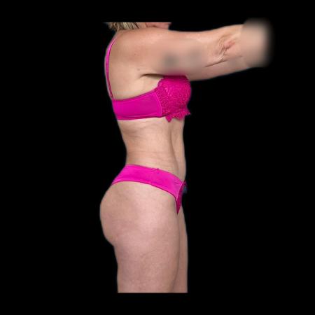 After image 6 Case #116076 - R.A.F.T LipoAbdominoplasty and LipoEsculture 