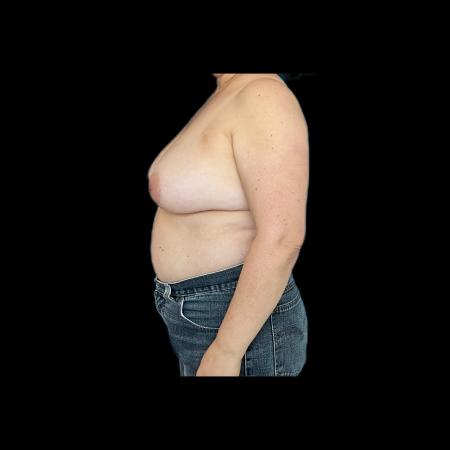 Before image 5 Case #118126 - Breast Lift without Implants 