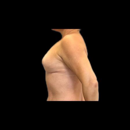 After image 3 Case #118141 - Mastopexy without Implants 