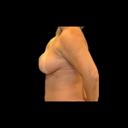 Before image 3 Case #118141 - Mastopexy without Implants 