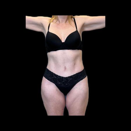 After image 6 Case #118136 - Pos-Bariatric