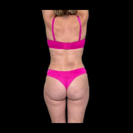 After image 5 Case #116076 - R.A.F.T LipoAbdominoplasty and LipoEsculture 