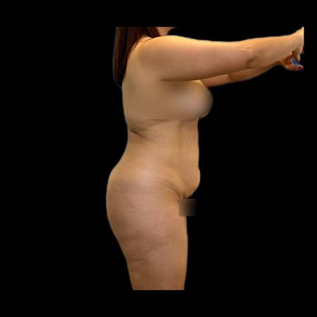 Before image 3 Case #118131 - R.A.F.T LipoAbdominoplasty