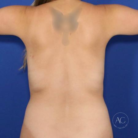 Before image 4 Case #118436 - Implant exchange, mastopexy, and liposuction