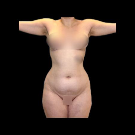 Before image 6 Case #118146 - R.A.F.T LipoAbdominoplasty