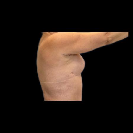 After image 5 Case #118141 - Mastopexy without Implants 