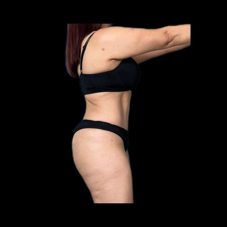 After image 3 Case #118131 - R.A.F.T LipoAbdominoplasty