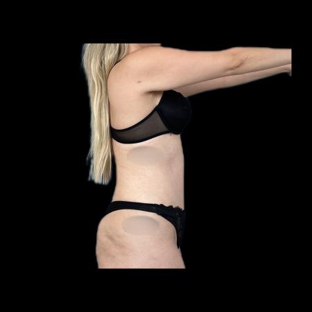 After image 5 Case #118146 - R.A.F.T LipoAbdominoplasty