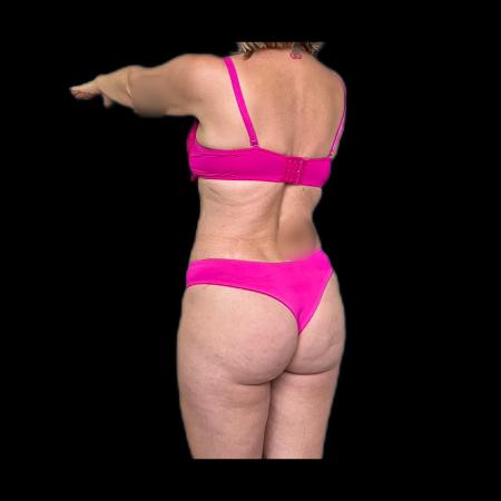 After image 4 Case #116076 - R.A.F.T LipoAbdominoplasty and LipoEsculture 