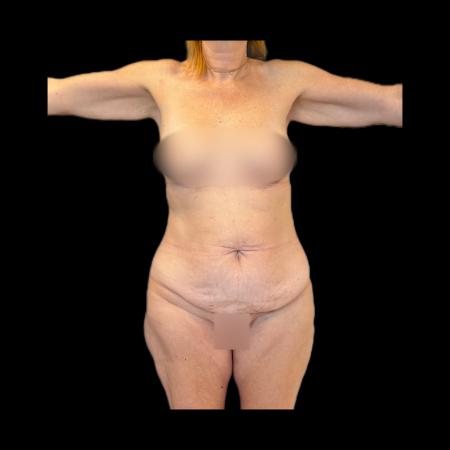 Before image 6 Case #118136 - Pos-Bariatric