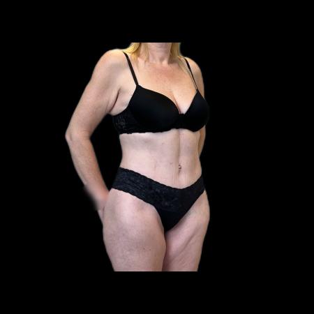After image 2 Case #118136 - Pos-Bariatric
