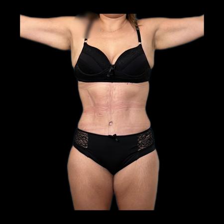 After image 6 Case #118121 - Post-Bariatric Surgery