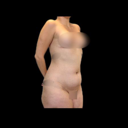 Before image 2 Case #118146 - R.A.F.T LipoAbdominoplasty