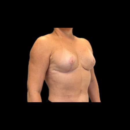 After image 6 Case #118141 - Mastopexy without Implants 