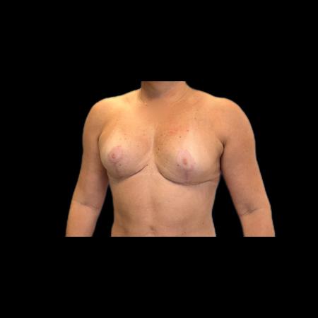 After image 4 Case #118141 - Mastopexy without Implants 