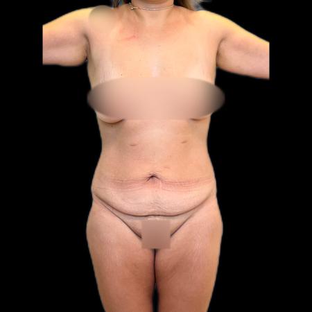Before image 6 Case #118121 - Post-Bariatric Surgery