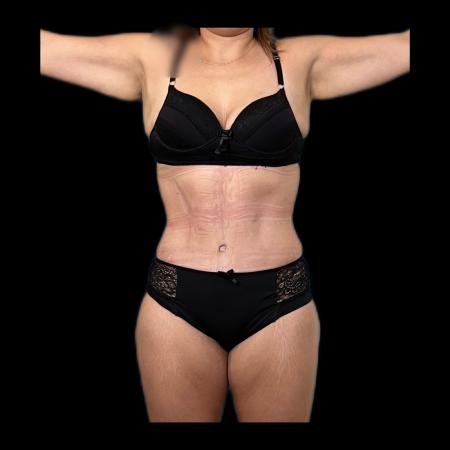 After image 1 Case #118121 - Post-Bariatric Surgery