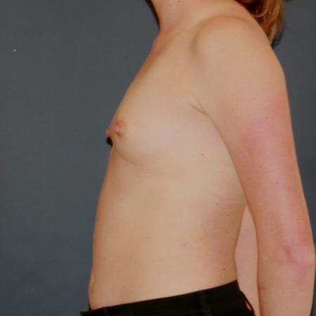 Before image 3 Case #118706 - Breast Augmentation