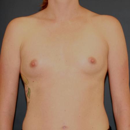 Before image 1 Case #118706 - Breast Augmentation