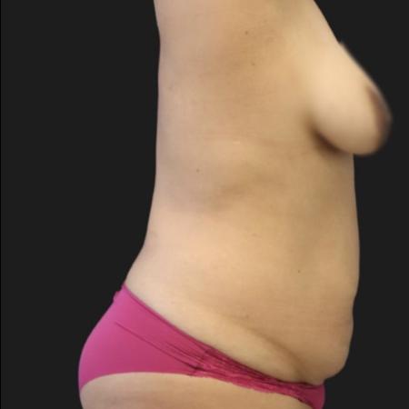 Before image 4 Case #119141 - 36-year old Patient | Mommy Makeover