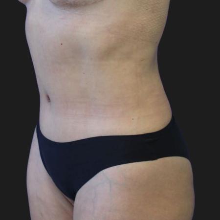 After image 3 Case #119276 - 48 year-old Patient | Tummy Tuck