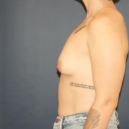 Before image 3 Case #119106 - Breast Augmentation