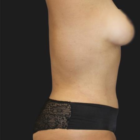 After image 4 Case #119141 - 36-year old Patient | Mommy Makeover