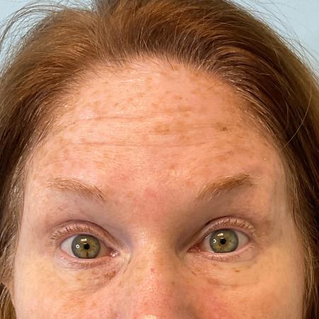 Before image 2 Case #119701 - Botox Injections