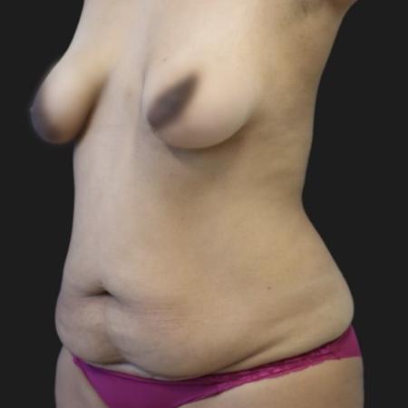 Before image 2 Case #119141 - 36-year old Patient | Mommy Makeover