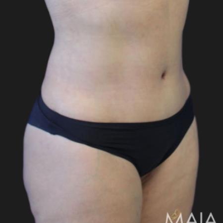 After image 2 Case #119276 - 48 year-old Patient | Tummy Tuck