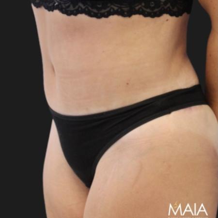 After image 2 Case #119131 - 53 year-old Patient | Mommy Makeover