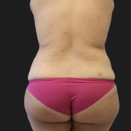 Before image 3 Case #119141 - 36-year old Patient | Mommy Makeover