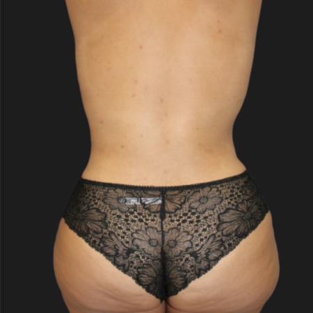 After image 3 Case #119141 - 36-year old Patient | Mommy Makeover
