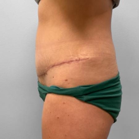 After image 3 Case #120861 - Abdominoplasty & Liposuction