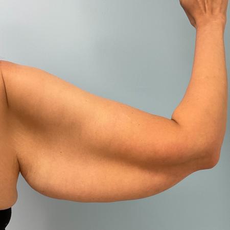Before Case #120891 - 42 year old female with Brachioplasty