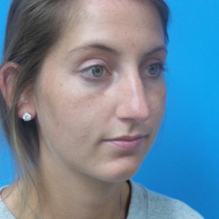 Before image 2 Case #121321 -   Open Rhinoplasty - 2 year post-op