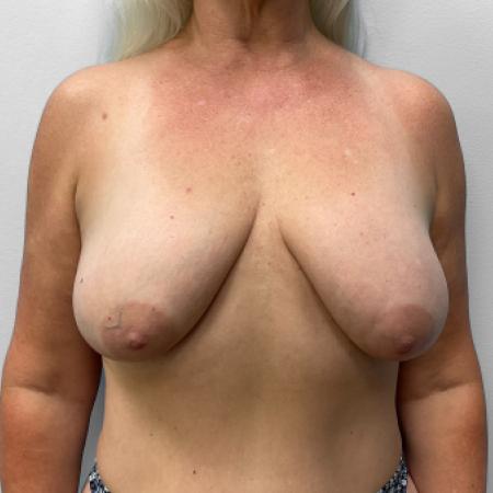 Before image 1 Case #120866 - Breast Augmentation with Lift